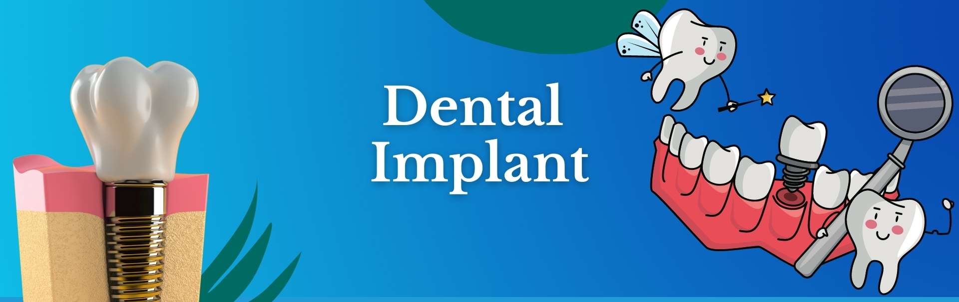 Dental Implant