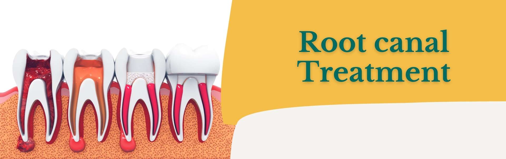 Root Canal
